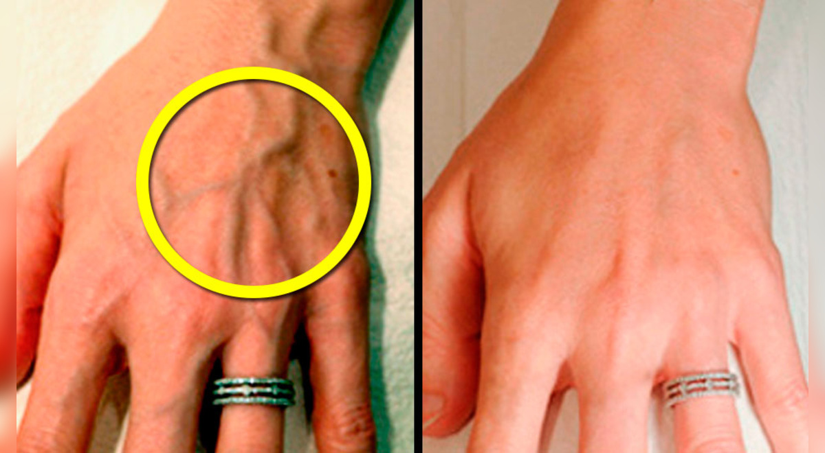 Por qué sobresalen las venas de las manos? Esto lo que revelarían de tu salud | Aweita La República