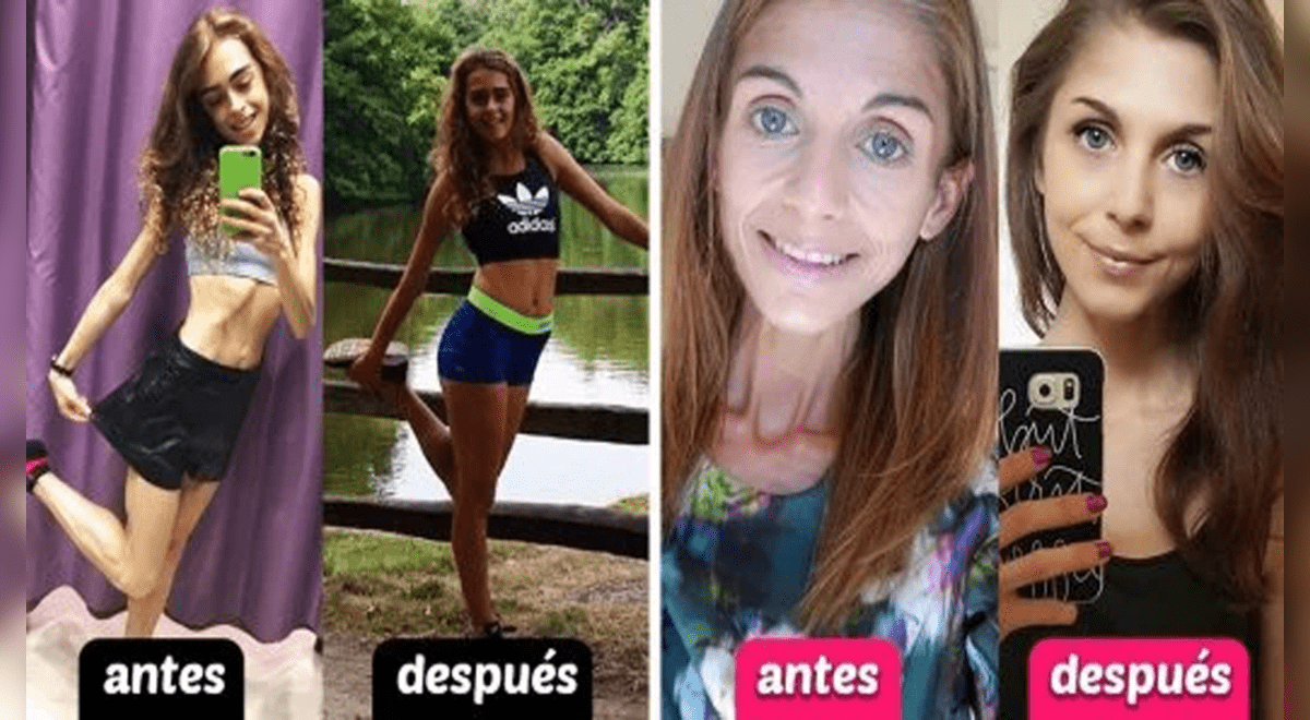 10 Mujeres Anoréxicas Que Compartieron El ‘antes Y Después De Su Recuperación Fotos Aweita