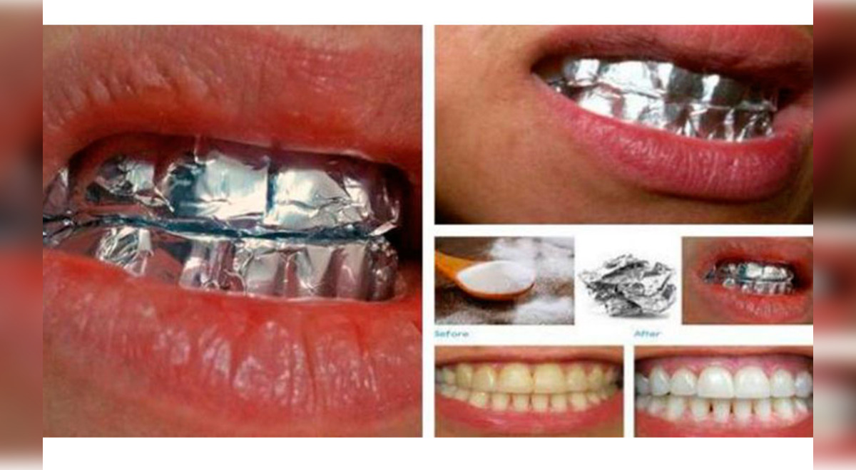 sistema manga Minimizar Realmente el papel aluminio blanquea los dientes? | Aweita La República