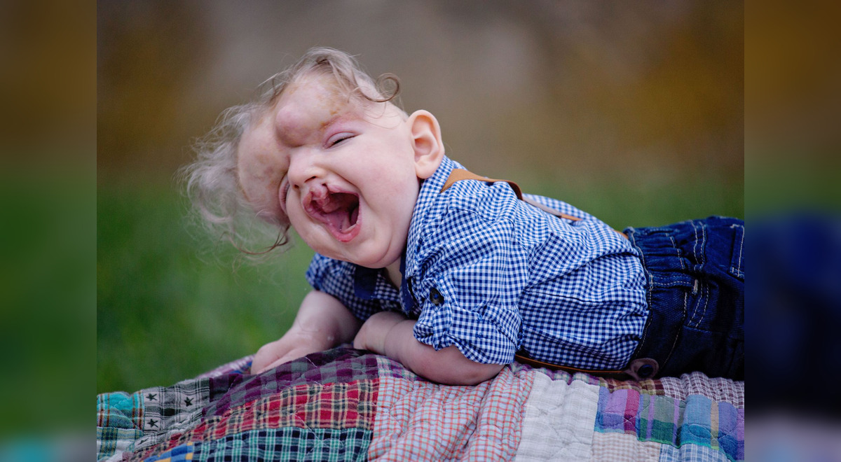 Bebé Que Nació Sin Cráneo Celebra Su Primer Cumpleaños Fotos Estados Unidos Acalvaria 3981