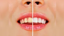 5 grandes consejos para blanquear tus dientes
