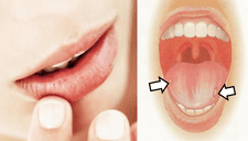 Aftas bucales: ¿Cómo curar esas molestas llagas en la boca?