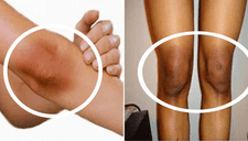 ¿Padeces de manchas negras en codos y rodillas?: Calma, tenemos la solución (FOTOS)
