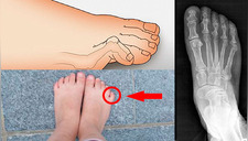 ¿El último dedo de tu pie está ‘doblado hacia adentro’? Estas son las causas