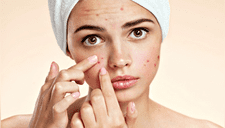 ¿Tienes acné? 4 cosas que no deberías hacer si amas tu piel (FOTOS) 