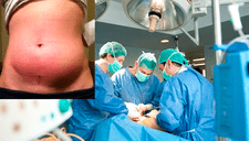Médicos extirparon un tumor de ovario de 60 kilos a una mujer; la operación duró cinco horas [FOTOS]