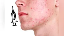 ¿Una vacuna contra el acné? Esto preparan los científicos y aseguran su efectividad