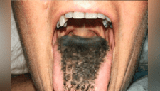 ¿Fuma o bebe alcohol? Doctores advierten que puede padecer de la "lengua negra peluda"  