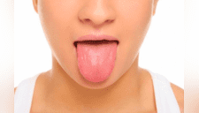 Sobrevive a un accidente y su lengua se vuelve negra y peluda; especialistas explican por qué