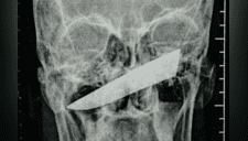 Hombre pasó cuatro días con un cuchillo clavado en la cabeza sin darse cuenta [FOTOS]