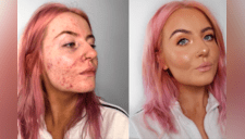 Influencer que sufre de acné enseña cómo maquillarse y causa furor en Instagram [FOTOS]