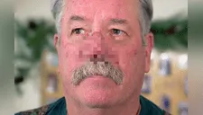 Su nariz creció el doble por culpa de extraña enfermedad, pero cirugía lo transformó [VIDEO] 