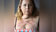 Argentina: su esposo la quemó y pasó por 50 operaciones [VIDEO]