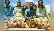 Tribu africana padece extraña malformación en sus pies y los confunden con patas de avestruz [FOTOS] 