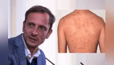 Político italiano “antivacunas” es internado por contraer varicela