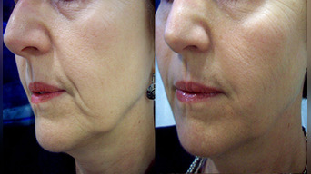 Flacidez en el rostro: esta crema casera podría restaurar tu piel en pocas semanas
