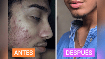 Maquillador de 19 años reveló su secreto para acabar con el acné