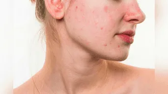 Si tienes acné con cicatrices, tu almohada sucia podría empeorar tu situación.