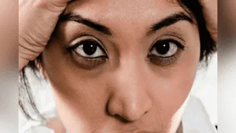 Las ojeras pueden ser síntoma de malos hábitos o de algún problema de tu organismo