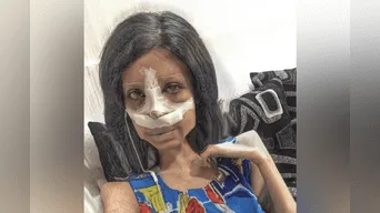 Las escalofriantes fotos de Sahar Tabar, la Angelina Jolie “zombie” tras nueva cirugía en su rostro.
