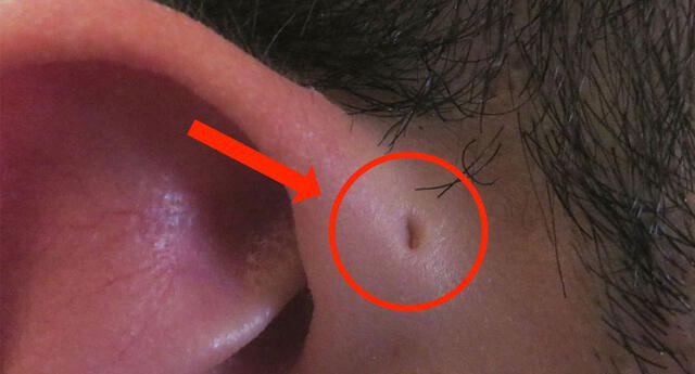 La explicación científica por qué algunos tienen un ‘agujero’ en la oreja