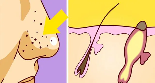 ¿Cómo eliminar los puntos negros de la nariz? 