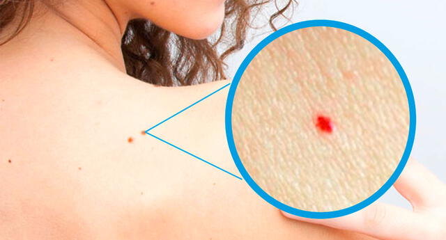 Salud: conoce qué significan las manchas rojas que aparecen en la piel