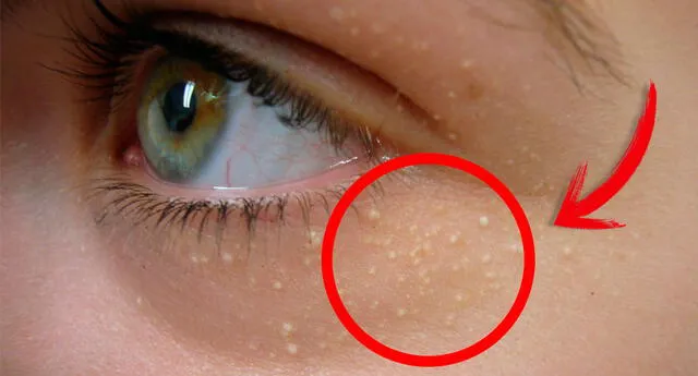 ¿Por qué salen ‘bolitas blancas’ cerca a los ojos? 6 trucos caseros para removerlas