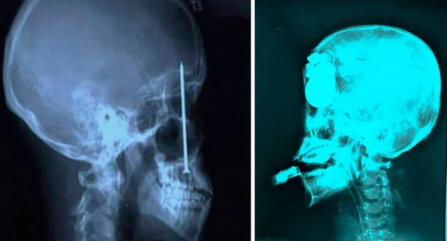 Los doctores nunca pensaron encontrar estas 16 increíbles cosas en radiografías 