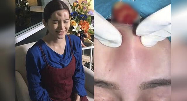Tailandesa tenía una inflamación en su frente, el doctor descubrió algo repugnante 