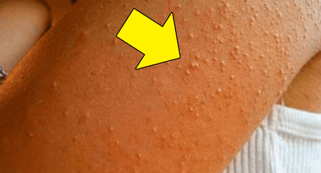 Los granitos rojos no solo aparecen por una simple alergia a los productos