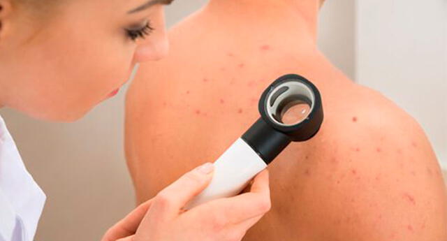 ¿Sufres de acné en la espalda? Esto es todo lo que debes saber para solucionarlo