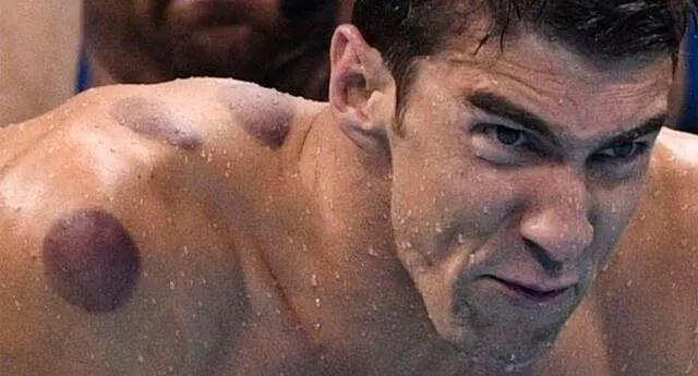 La razón de por qué la espalda de Phelps tiene círculos rojos