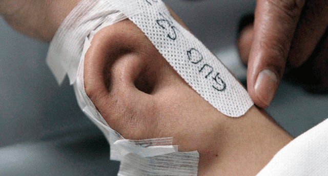 Los médicos injertaron una oreja en el antebrazo de la soldado estadounidense