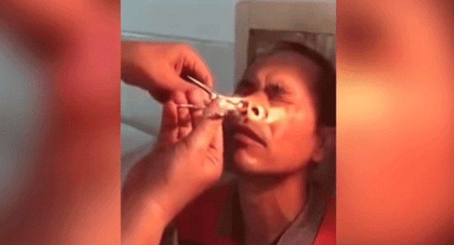 Un médico chino extrajo una sanguijuela de las fosas nasales de un paciente.