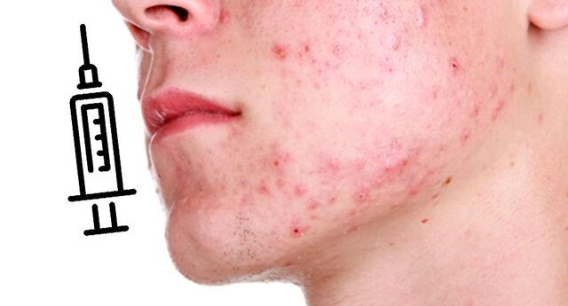 La vacuna pondría fin a las terribles secuelas del acné.