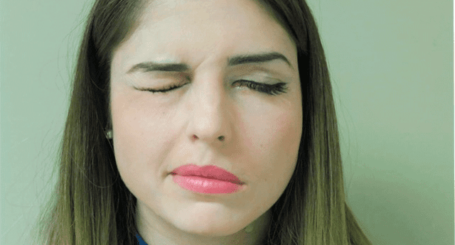 Una de las principales causas de parálisis facial es estar constantemente estresado.