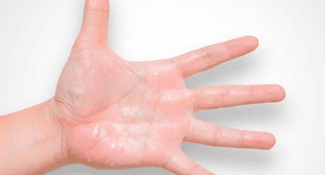 La sudoración excesiva en las manos, denominada “Hiperhidrosis palmar”