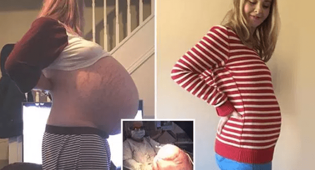 Mujer creyó estar embarazada de sixtillizos, pero en realidad tenía un tumor de 5 kilos.
