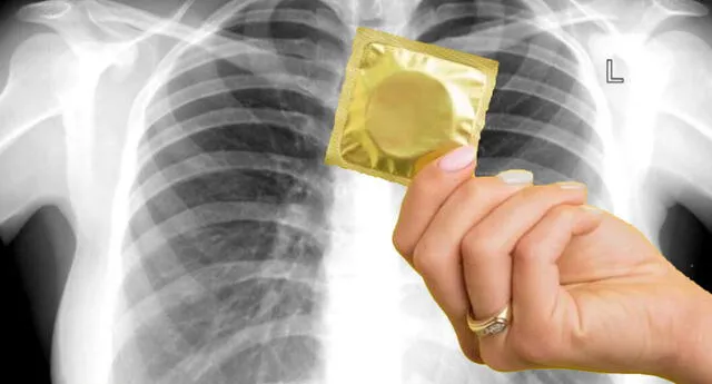 ¡Insólito! Médicos encuentran condón en pulmón joven de 27 años, caso se hace viral